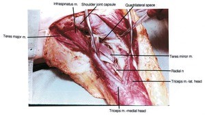 Natural color photograph of dissection of the right shoulder and upper arm, posterolateral view, showing musculature with the triceps muscle retracted to expose the radial nerve and teres minor