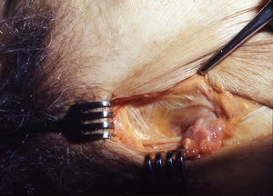 Natural color photograph of dissection of the inguinal region