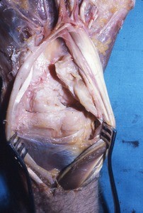 Natural color photograph of dissection of the left wrist, anterior view, exposing bones