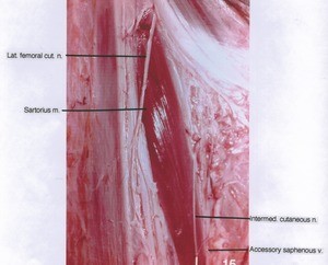 Natural color photograph of right hip, anterior view, showing muscle, vein and nerves