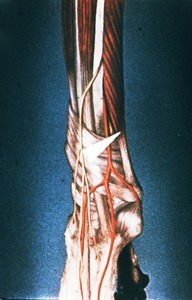 Illustration of right forearm and wrist, lateral view, white arrowhead pointing at the tendon of extensor carpi radialis longus at its origin from the muscle