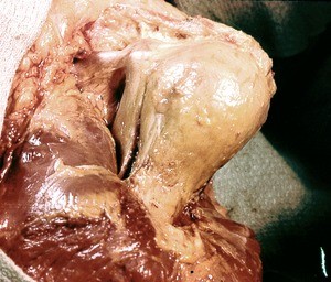 Natural color photograph of dissection of the left shoulder, anterior view, with the deltoid muscle reflected to reveal the glenohumeral joint capsule