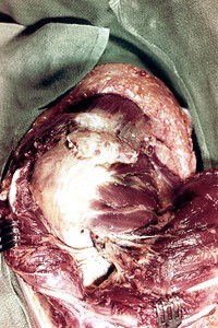 Natural color photograph of dissection of the left shoulder, posterior view, with the deltoid muscle reflected to reveal the glenohumeral joint capsule and the rotator cuff muscles