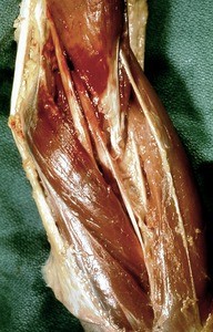 Natural color photograph of dissection of the left cubital fossa, anterior view