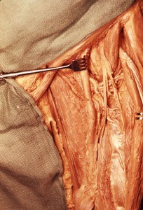 Natural color photograph of dissection of the left thigh, anterior view, showing the femoral artery, its branches, and the femoral nerve