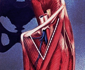 Illustration of left inguinal region and thigh, "centered" on femoral triangle and its contents