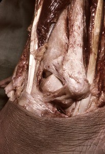 Natural color photograph of dissection of the left ankle, lateral view, exposing the fibula and related structures