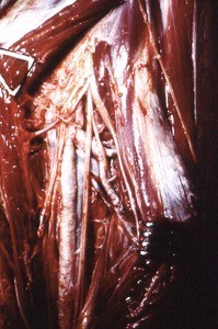 Natural color photograph of dissection of the left thigh, anterior view, exposing the femoral artery, vein and nerve