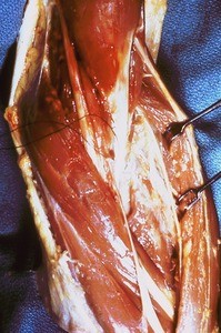 Natural color photograph of dissection of the left cubital fossa, anterior view, with the brachioradialis muscle retracted to expose the branches of the radial nerve