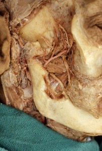 Natural color photograph of dissection of the temporal fossa, showing branches of the maxillary artery and the mandibular nerve