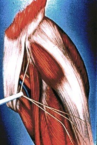 Illustration of dissection of left inguinal region and upper thigh, anterior view, showing muscles and vessels with the lateral femoral cutaneous nerve retracted