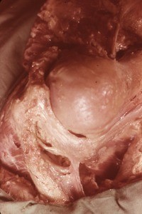 Natural color photograph of dissection of the left shoulder, superolateral view, with the deltoid muscle reflected to show bones and ligaments of the shoulder