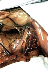 Natural color photograph of dissection of the lower abdominal and pelvic cavity, anterior view, showing the sigmoid colon, veins, and arteries