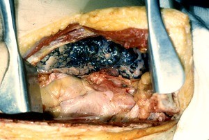 Natural color photograph of dissection of the left thorax, anterior view, with an incision through the chest wall to expose the lung, heart, and ascending aorta