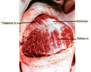 Natural color photograph of dissection of the right shoulder, lateral view, showing the acromion, deltoid muscle, and trapezius muscle