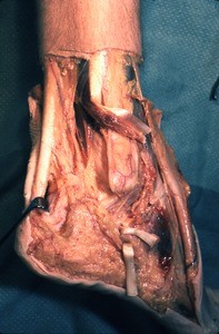 Natural color photograph of dissection of the right ankle, lateral view, with the fibularis longus t. and fibularis brevis t. cut