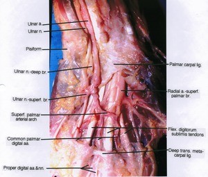 Natural color photograph of wrist and hand, palmar surface, showing tendon, arteries, nerves and ligaments