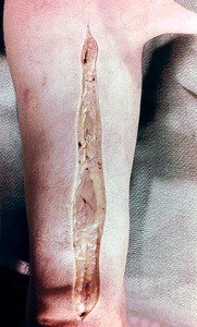 Natural color photograph of superficial dissection of the right arm, anterior view