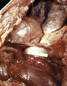 Natural color photograph of dissection of the right thorax, anterior view, showing a hernia extending into the right pleural cavity