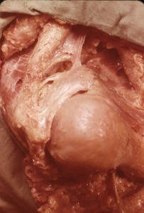 Natural color photograph of dissection of the right shoulder, superolateral view, with the deltoid muscle reflected to expose the humerus and its associated ligaments