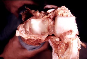 Natural color photograph of dissection of the ankle, disarticulated, showing the articular surfaces of the tibia, fibula and the talus