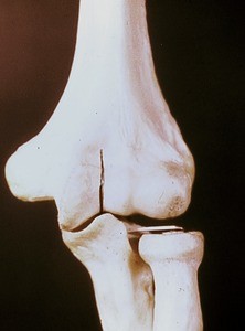 Bones of the elbow, anterior view, including the humerus, the radius and the ulna