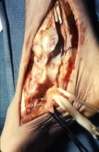 Natural color photograph of dissection of the right ankle, medial view, with the tibialis posterior t. and the flexor digitorum longus t. cut and reflected