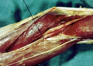Natural color photograph of dissection of the left cubital fossa, anterior view