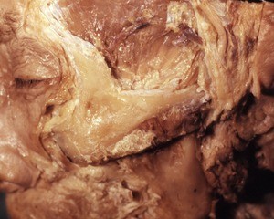 Natural color photograph of dissection of the face, left lateral view, showing the zygomatic arch and the temporal fossa