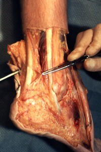 Natural color photograph of dissection of the right ankle, lateral view, emphasing the Achilles tendon