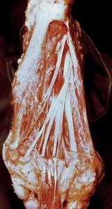 Natural color photograph of dissection of the plantar surface of the left foot