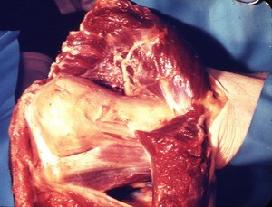 Natural color photograph of dissection of the left shoulder, anterior view, with the deltoid muscle reflected to expose the underlying bones, muscles, nerves, and tendons