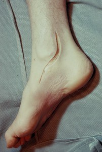 Natural color photograph of dissection of the right ankle, medial view, showing initial incision