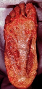 Natural color photograph of dissection of the plantar surface of the right foot