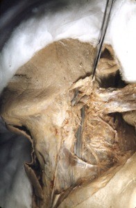 Natural color photograph of dissection of the left side of the neck, lateral view, with the sternocleidomastoid muscle reflected to expose the underlying nerves and vessels