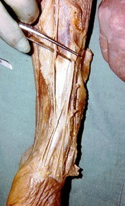 Natural color photograph of dissection of the forearm