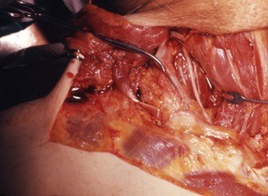 Natural color photograph of dissection of the right side of the neck, anterior view, with the sternocleidomastoid and omohyoid muscles cut and reflected to expose the underlying vessels and nerves