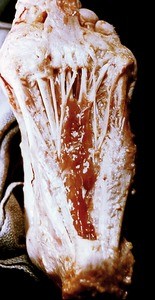 Natural color photograph of dissection of the plantar surface of the left foot