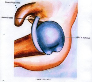 Illustration of the left glenohumeral joint, superolateral view, showing the relationship between bone structure and the biceps brachii tendon (long head) during a lateral dislocation