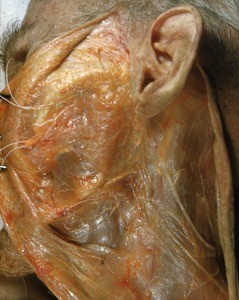 Natural color photograph of dissection of the left side of the neck, lateral view, with the skin reflected to expose underlying fascia and nerves