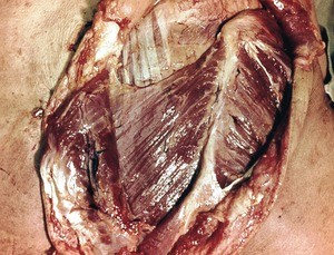 Natural color photograph of dissection of the left shoulder, posterior view, with the skin and trapezius muscle reflected to expose the rhomboid major muscle attaching to the medial border of the scapula