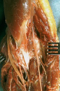 Natural color photograph of dissection of the left cubital fossa, anterior view