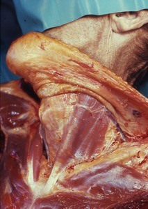 Natural color photograph of dissection of the neck, anterolateral view, highlighting the sternocleidomastoid m