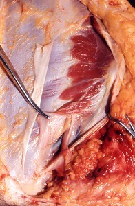 Natural color photograph of dissection of the left inguinal region, anterior view, showing the inguinal ligament and the deep inguinal ring with the spermatic cord exiting