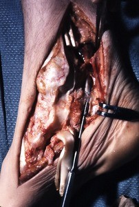 Natural color photograph of dissection of the right ankle, medial view, with a probe through the tendinous sheath of the flexor hallucis longus t