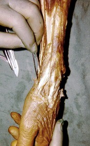 Natural color photograph of dissection of the left wrist, lateral view