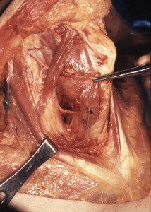 Natural color photograph of dissection of the neck, anterior view, with the sternocleidomastoid muscles retracted laterally to expose the superior belly of the omohyoid muscle and nerves of the anterior neck