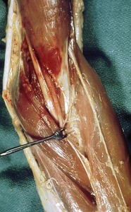 Natural color photograph of dissection of the left cubital fossa, anterior view