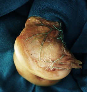 Natural color photograph of dissection of the lateral and medial condyles of the femur