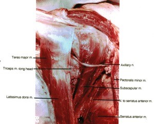 Natural color photograph of right axilla, anterior view, showing muscles, muscle attachments and the course of the axillary nerve